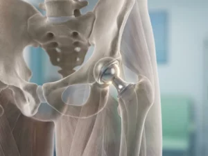 Medische illustratie van heupprothese implantaat in transparante weergave van heupgewricht met bekken en dijbeen