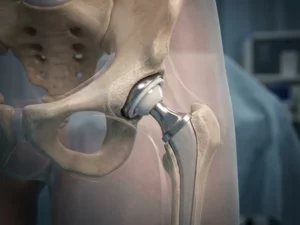 Heupprothese implantaat in transparante dwarsdoorsnede van menselijke heupanatomy met botstructuur en weefsels