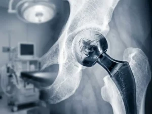 Röntgenfoto van heupprothese met slijtage op metalen kogel en stressfracturen in kunstgewricht