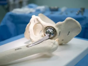 Titanium heupprothese in anatomisch model van heupgewricht op medische onderzoekstafel in ziekenhuisomgeving