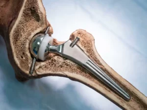 Doorsnede van heupgewricht met titanium heupprothese geïmplanteerd in dijbeenbotstructuur, medische precisie zichtbaar