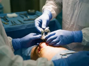Chirurg plaatst titanium knieprothese tijdens partiële knievervanging, steriele instrumenten op operatietafel zichtbaar