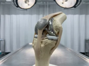 Anatomisch kniemodel met gedeeltelijke en complete prothese-onderdelen op medische onderzoekstafel