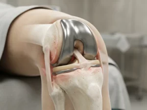 Gedeeltelijke knieprothese in anatomische doorsnede met tekenen van ontsteking en loslating in botweefsel