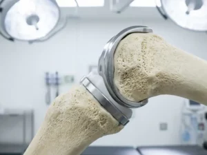 Doorsnede van menselijke knie met gedeeltelijke titanium prothese-implantaat in botstructuur, medische precisie