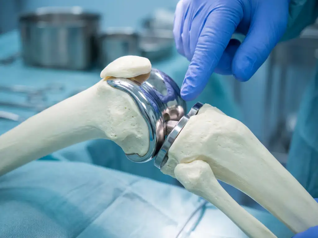Medisch kniegewrichtmodel met gedeeltelijke knieprothese, doktershand wijst naar verbindingspunt tussen implantaat en bot