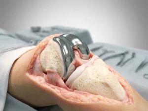 Doorsnede van knie met titanium prothese-implantaat in botstructuur omgeven door gezond weefsel