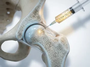 Medische illustratie van heupgewricht met spuit met gouden stamcellen bij injectiepunt voor behandeling