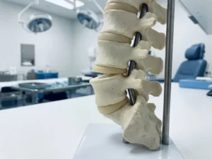 Anatomisch wervelkolommodel met één verschoven wervel, illustreert spondylolisthesis op klinisch oppervlak.